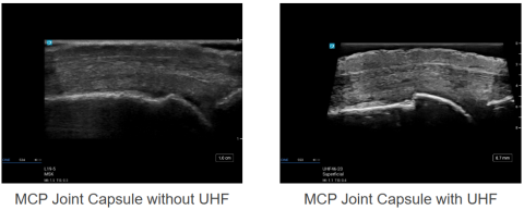 Ultrahögfrekvent scanningsfoto