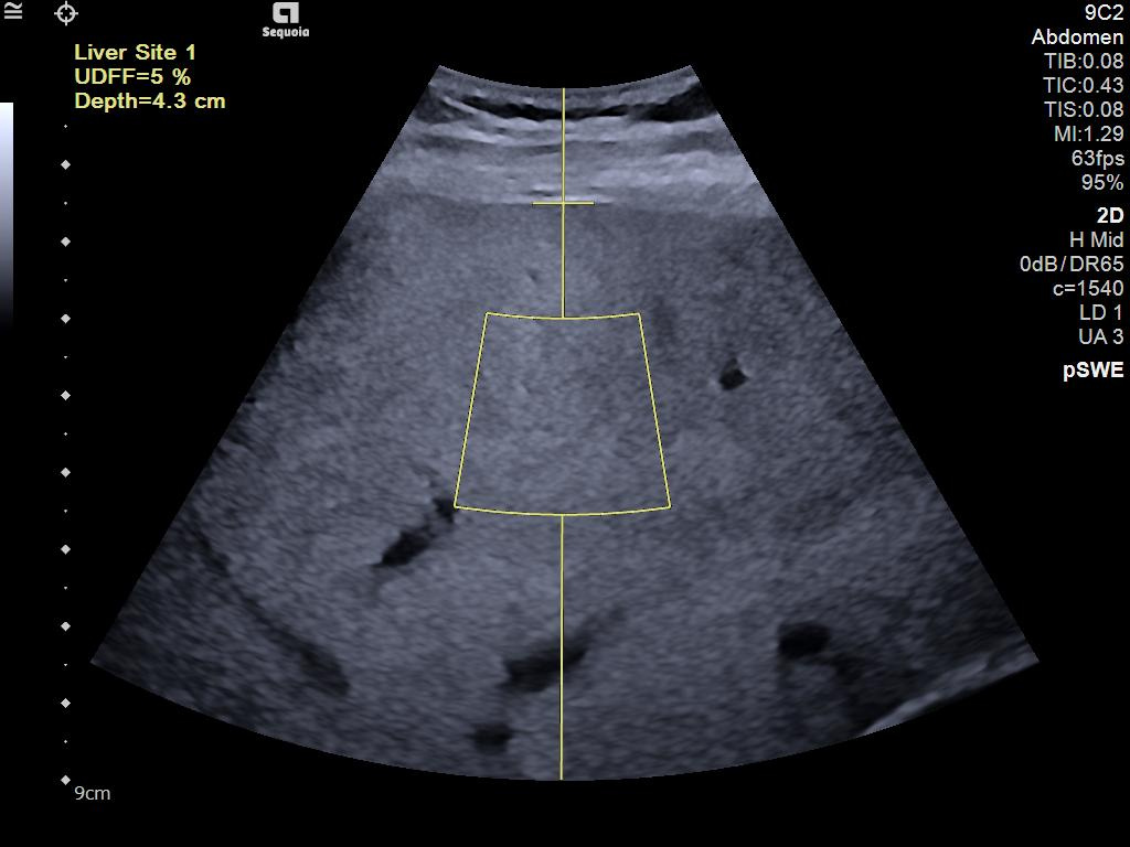 Siemens Sequoia - Clinical Image - Abdominal 3