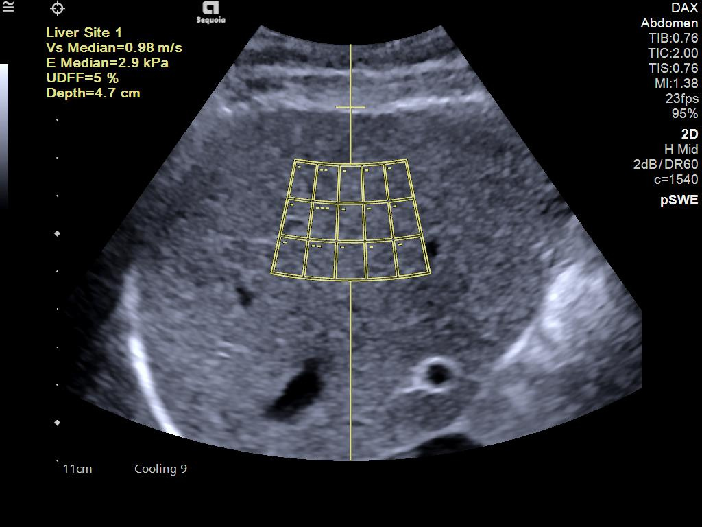 Siemens Sequoia - Clinical Image - Abdominal 4