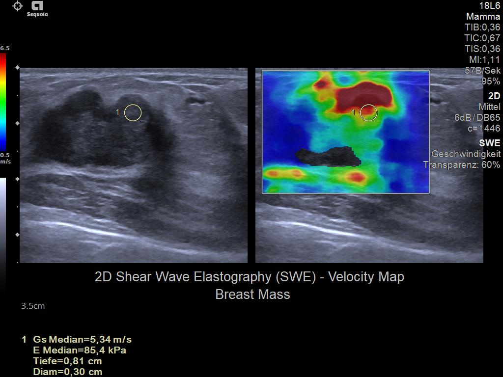 Siemens Sequoia - Clinical Image - Breast 1
