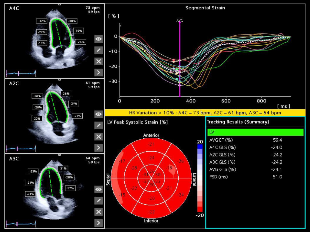 Siemens Sequoia - Clinical Image - Cardiac 3