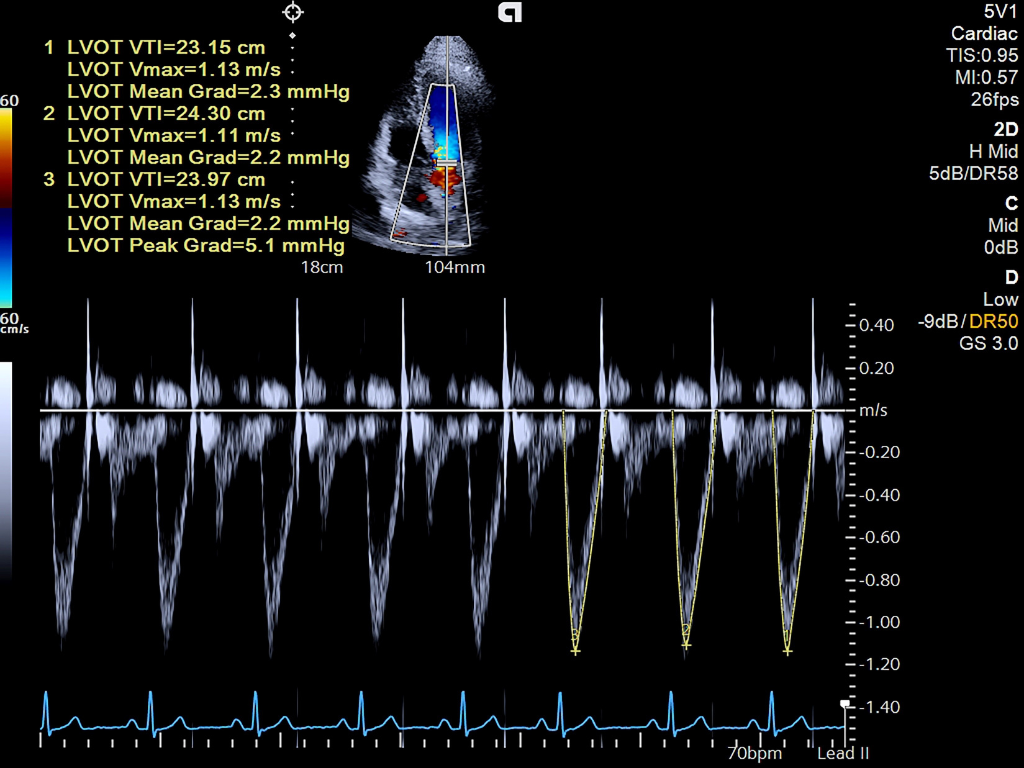 Siemens Sequoia - Clinical Image - Cardiac 4