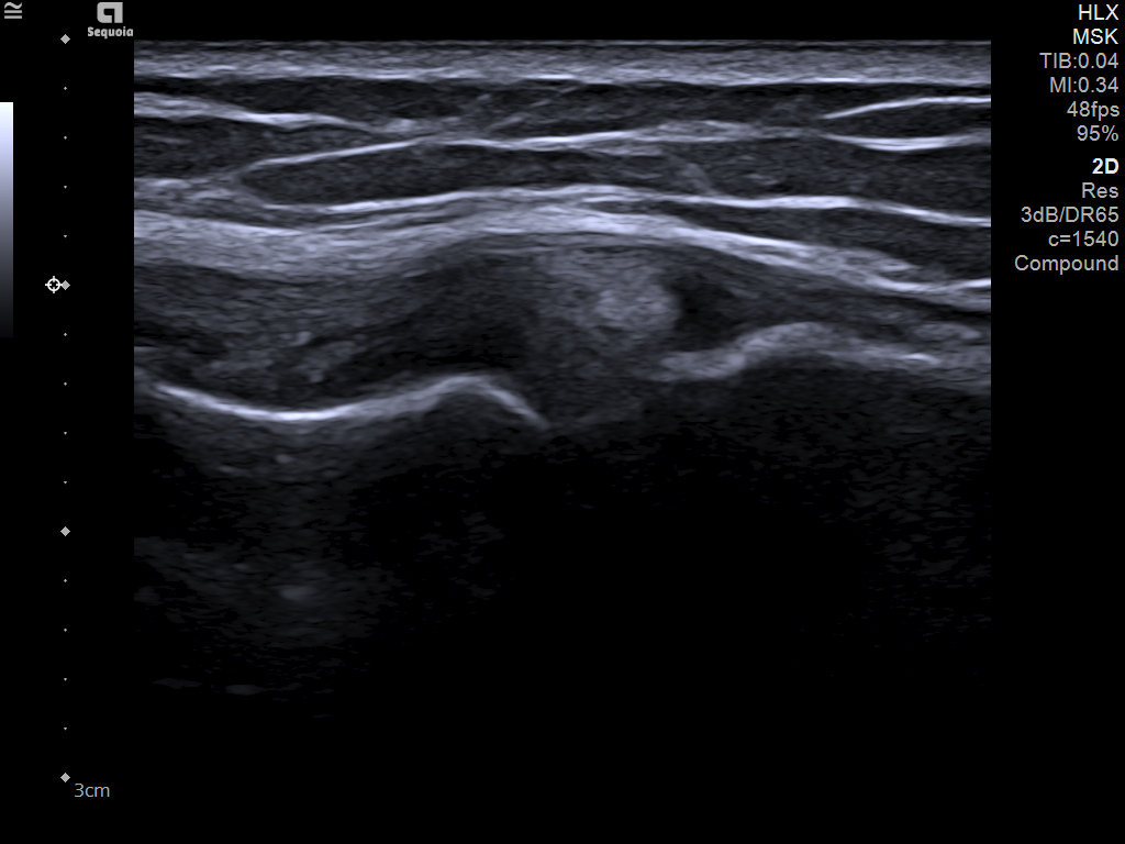 Siemens Sequoia - Clinical Image - MSK 1