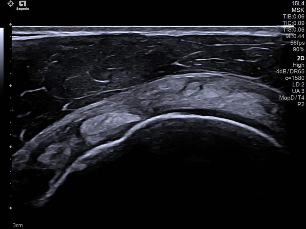 Siemens Sequoia - Clinical Image - MSK 2