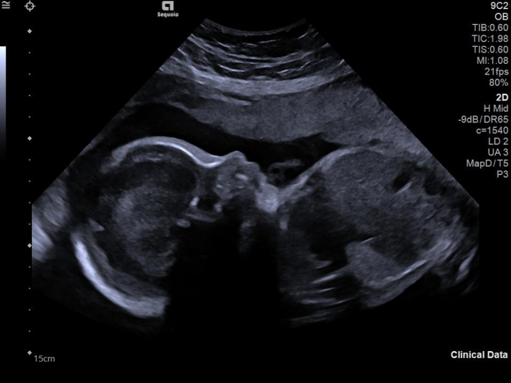 Siemens Sequoia - Clinical Image - OB-GYN 2
