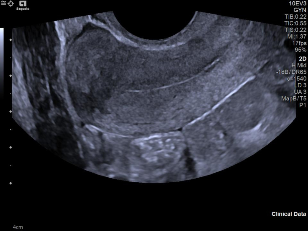 Siemens Sequoia - Clinical Image - OB-GYN 3