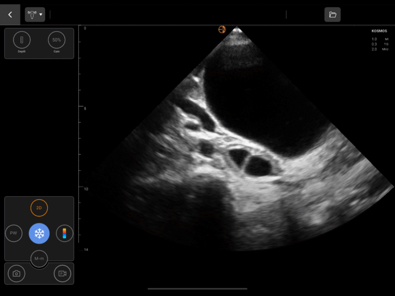 GYN-Left-Overy-768x576